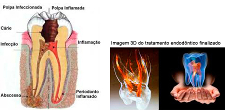 endodontia-5